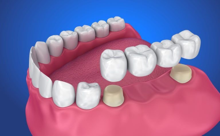 Dental Consumables: A Complete Buying Guide for Dentists & Dental Clinics | SkyMedIdent Dental crown and Bridge 768x476.jpg.optimal