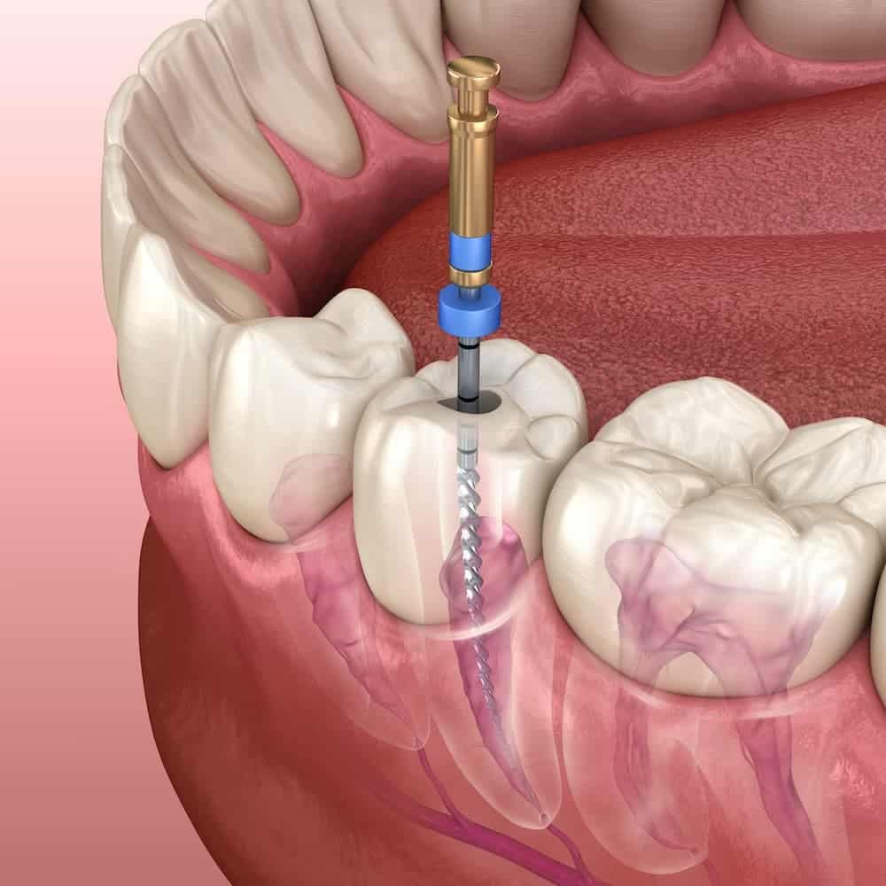 Dental Consumables: A Complete Buying Guide for Dentists & Dental Clinics | SkyMedIdent Endodoncija 3