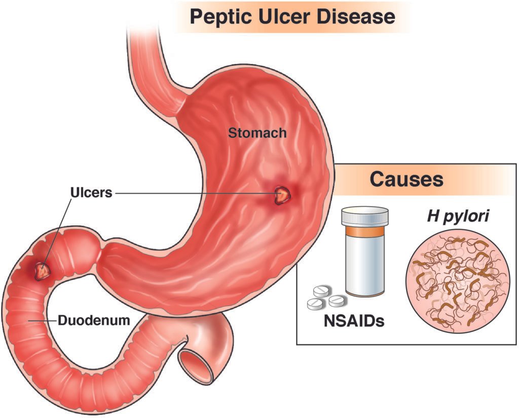 Understanding Peptic Ulcer Disease: Causes, Symptoms & Treatment | SkyMedIdent CGH Patient ed ulcer 2018 1024x824 1