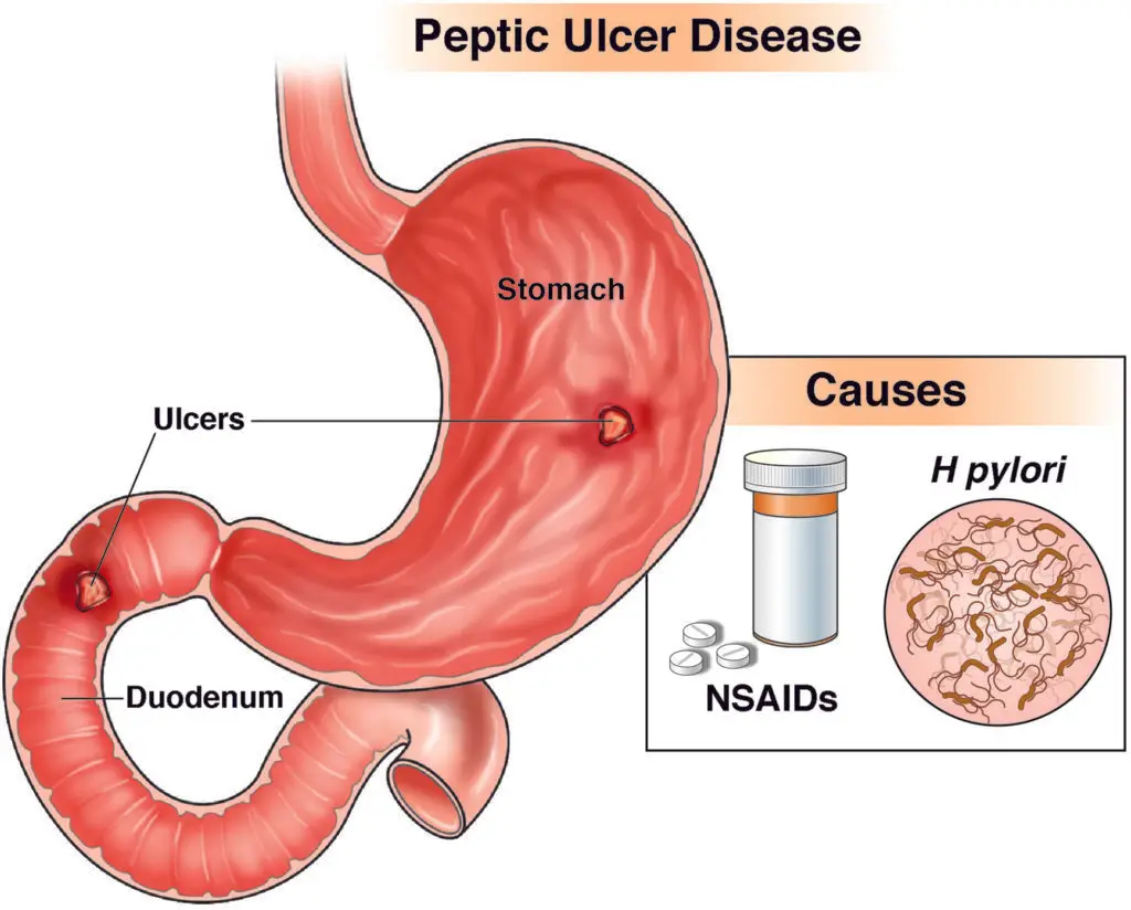 CGH Patient ed ulcer 2018 1024x824 1