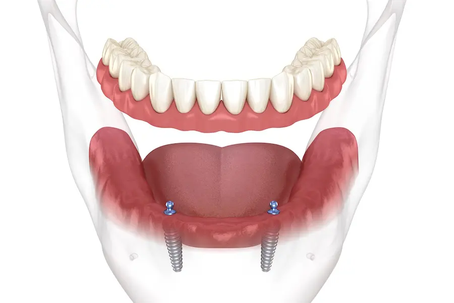 Understanding Overdentures: Causes, Symptoms & Treatment | SkyMedIdent GettyImages 1345444888.jpg