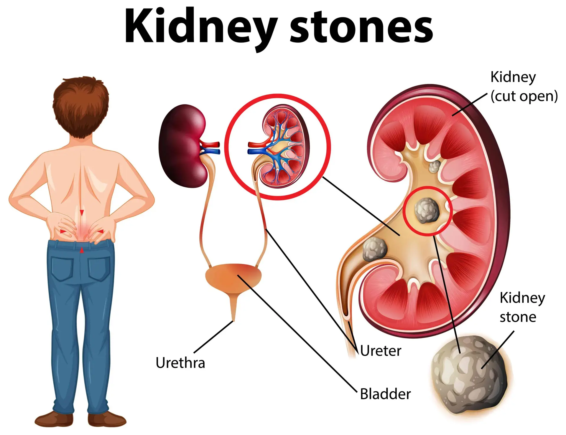 Kidney Stones scaled 1