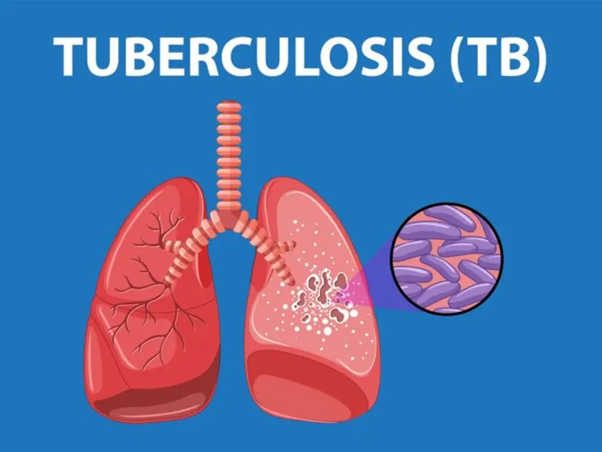 Tuberculosis1705674281