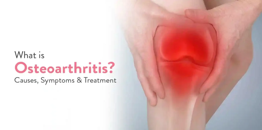 What is Osteoarthritis Causes Symptoms and Treatment thumbnail compressed