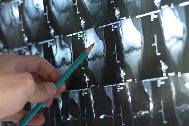 Orthopaedic Products, Supports & Rehabilitation Equipment: A Complete Guide | SkyMedIdent doctor examining bone knee tumor x ray and mri mrt ct with marked sclerosis around the nidus