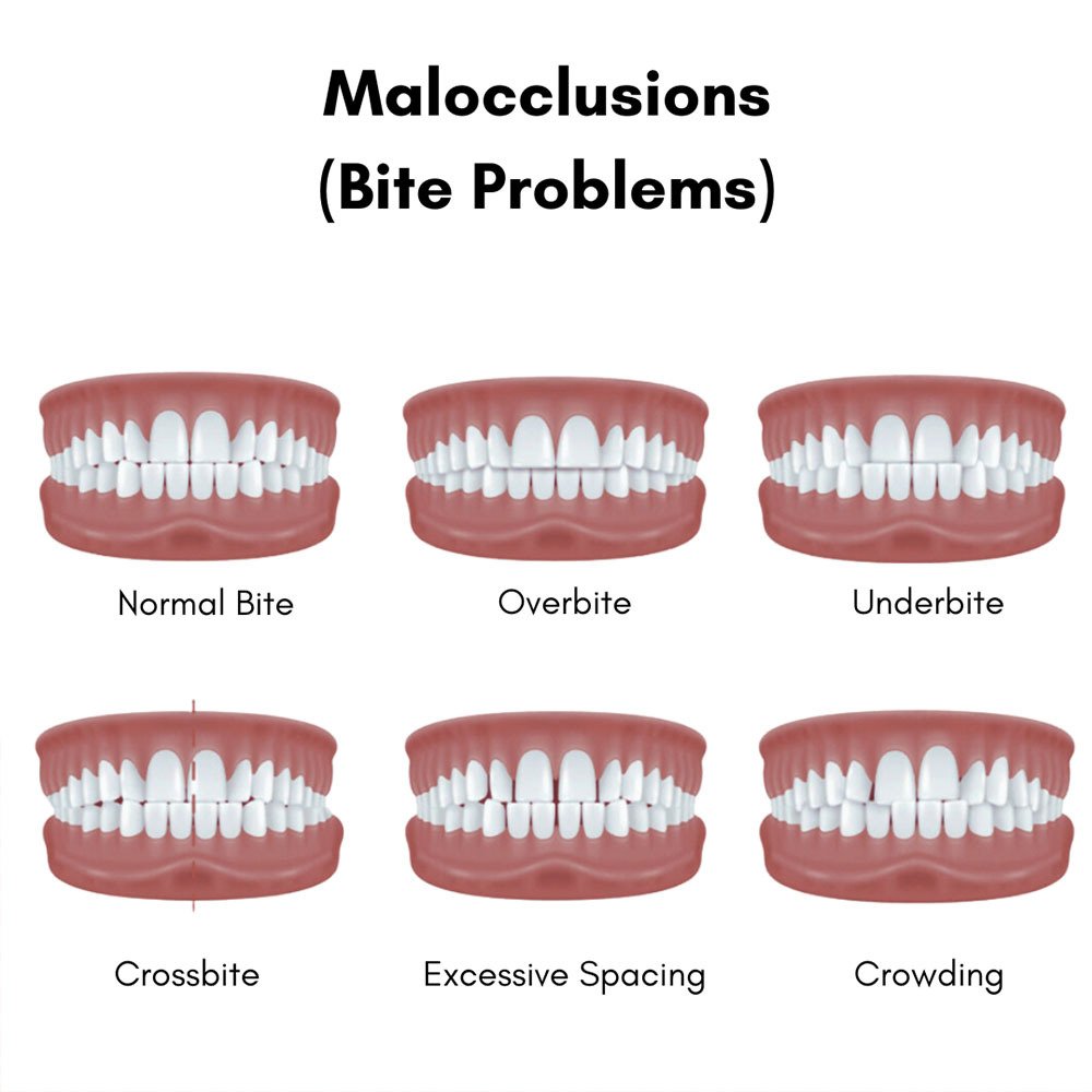 Understanding Malocclusion: Causes, Symptoms & Treatment | SkyMedIdent malocclusions treatment in brooklyn