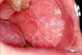 Understanding Oral Lichen Planus: Causes, Symptoms & Treatment | SkyMedIdent oral lichen planus 1