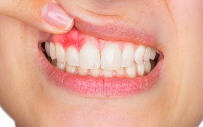 what is gingivitis